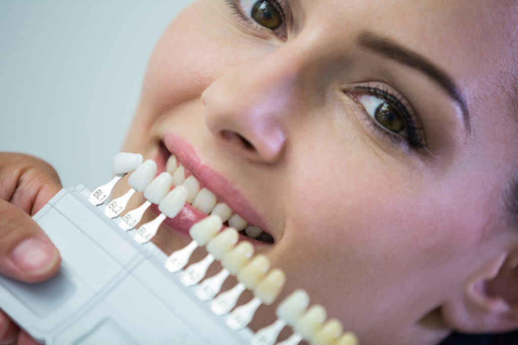 porcelain veneers in Ventura