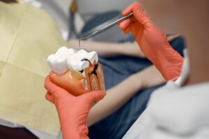 Dental Sealants