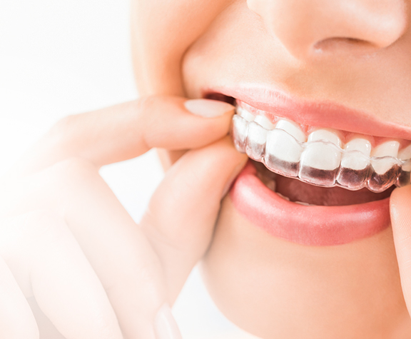 Invisalign dentist in Ventura