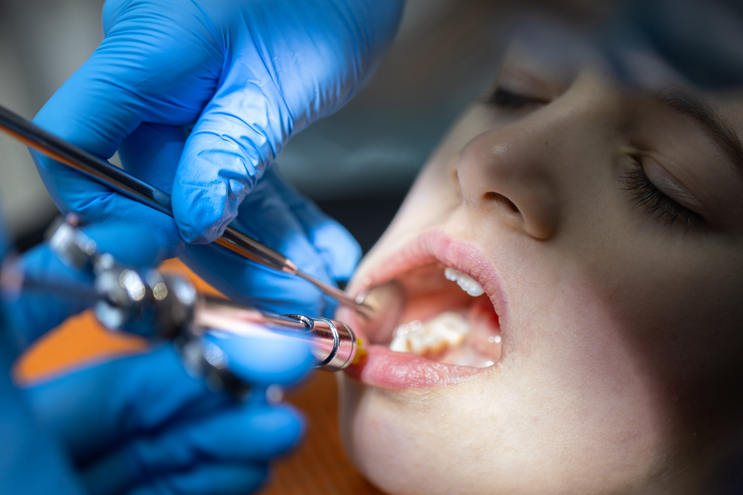 dental fillings